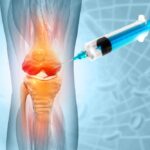 Anatomy,Human,Knee,Joint,Treatment,,Osteoarthritis,Injection,,Drug,Method,Injection,