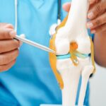 Knee,Osteoarthritis,,Doctor,Showing,Model,Knee,Joint,Orthopedic.