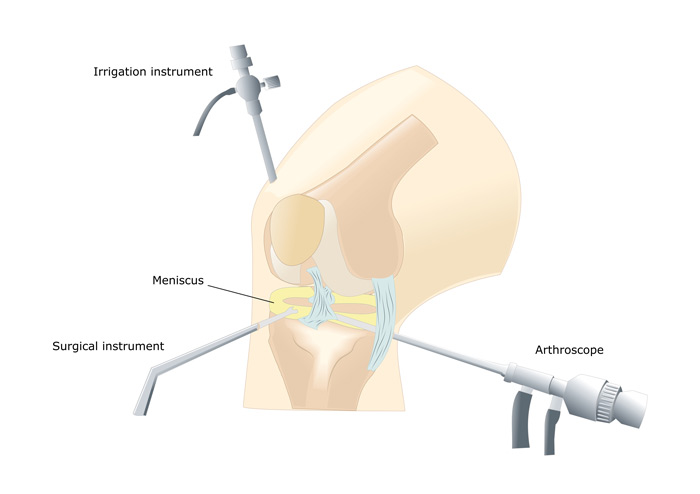 arthroscopy camera